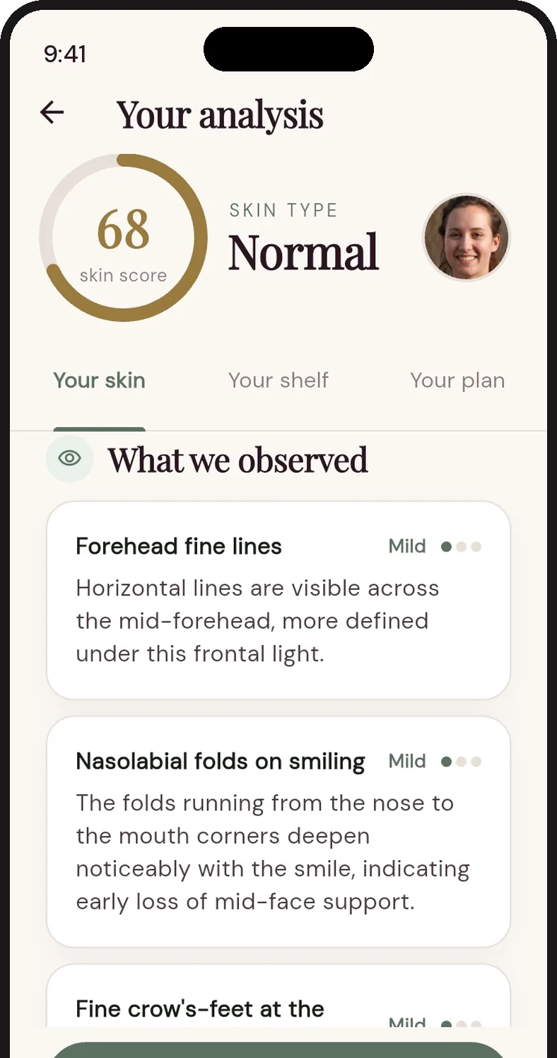 Anchored observations: fine lines on the forehead and nasolabial folds on smiling, both mild.